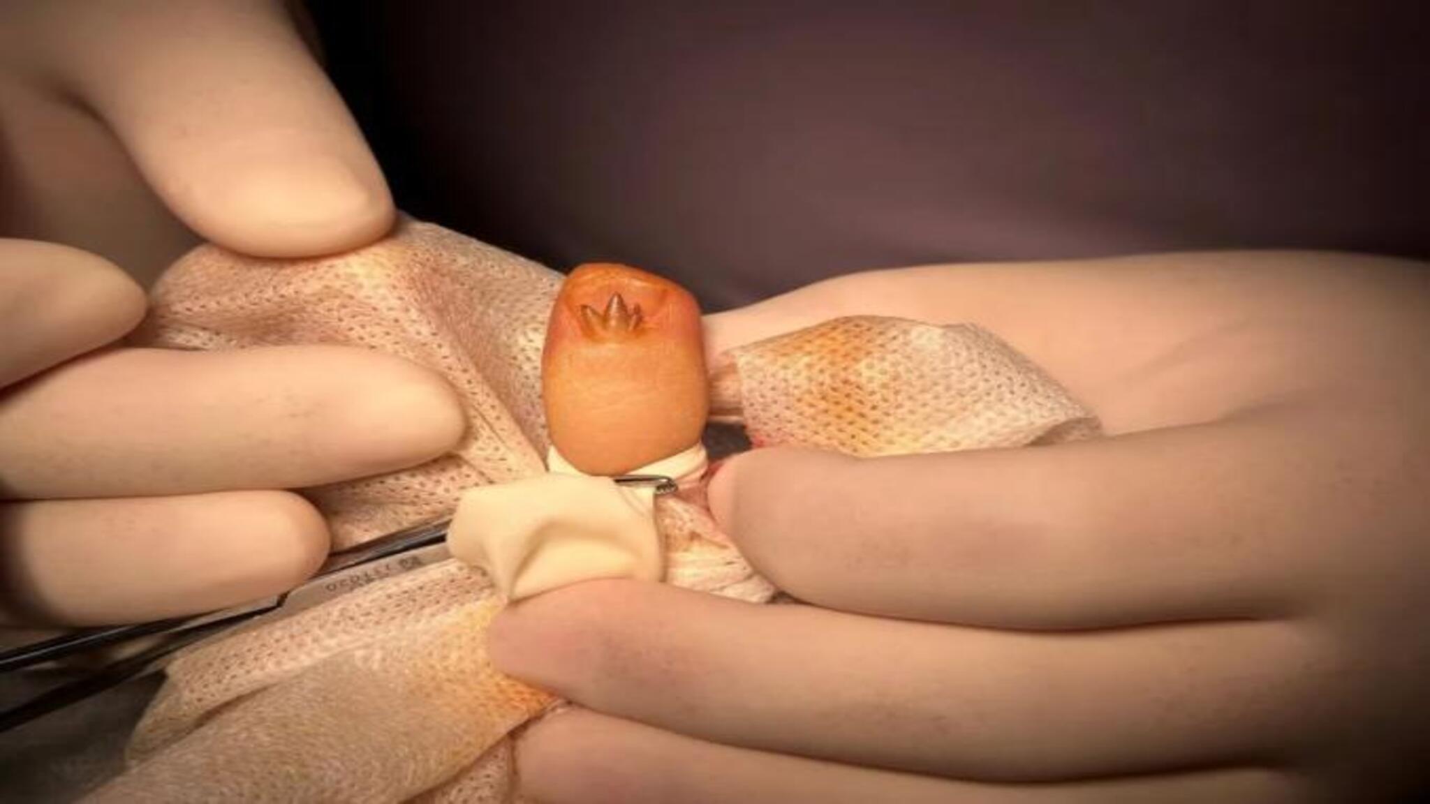 美甲引发的增生组织，医生提醒要小心